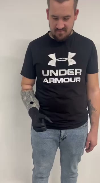 Esper Hand prosthetics video 1